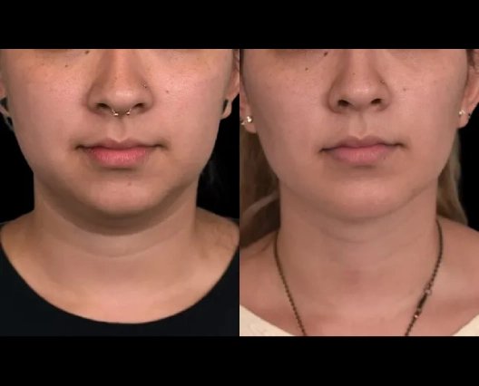 How the Best Double chin removal Surgeon in dubai Delivers Consistent Results