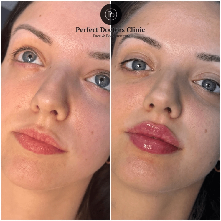 Your Path to Youthful Skin with Juvederm in Dubai